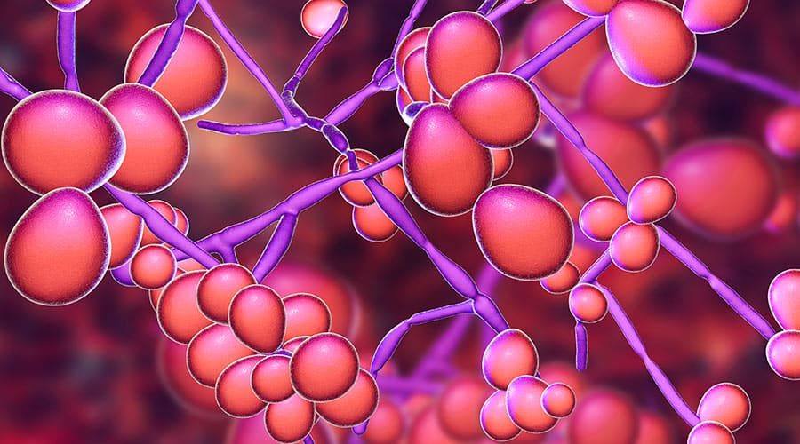 Candidiasis