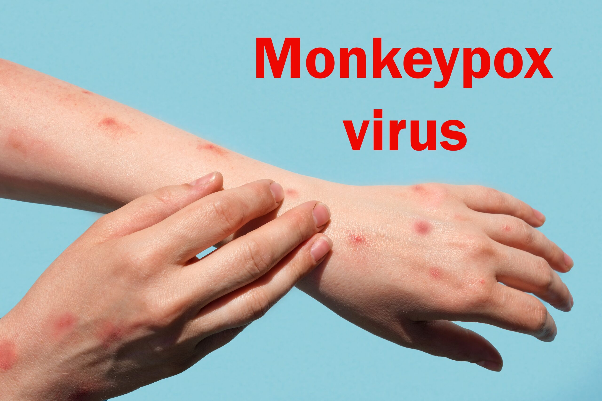 Monkeypox symptoms and treatment