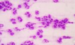A Nurse’s Guide to Managing Sepsis 
