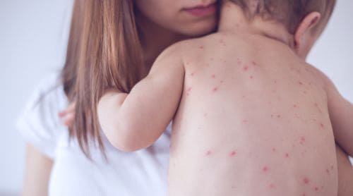 MMR Vaccine: A Review of Measles, Mumps, and Rubella for Pharmacists