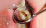 Beyond the Enamel: A Clinical Guide to Erosion-Related Tooth Wear