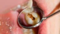 Beyond the Enamel: A Clinical Guide to Erosion-Related Tooth Wear