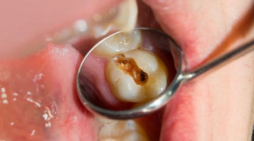 Beyond the Enamel: A Clinical Guide to Erosion-Related Tooth Wear