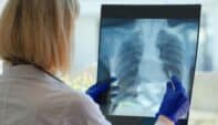 What Clinicians Should Know About Lung Cancer