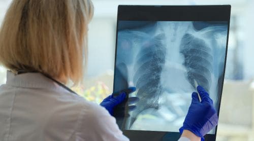 What Clinicians Should Know About Lung Cancer