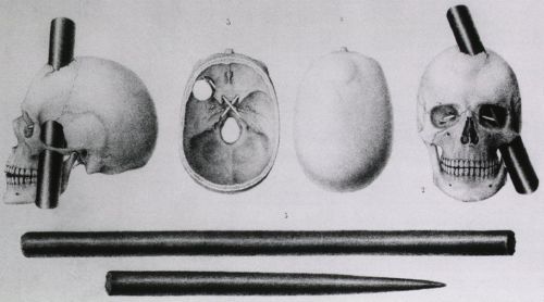 Spine-Chilling Cases from Medical History