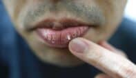 Managing Dry Mouth: The Role of Saliva