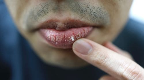 Managing Dry Mouth: The Role of Saliva