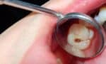 Treating Caries-Prone Patients