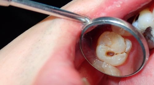 Treating Caries-Prone Patients