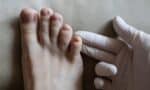 The Fungus Among Us: Treating Fungal Skin Diseases