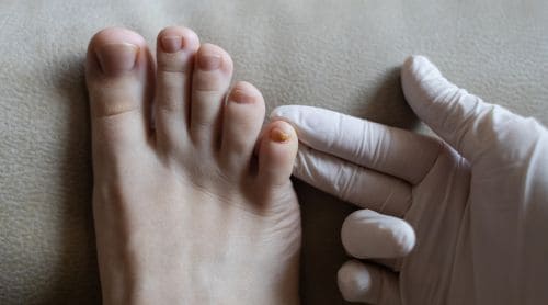 The Fungus Among Us: Treating Fungal Skin Diseases