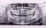 Staying Safe with Dental Radiation