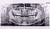 Staying Safe with Dental Radiation