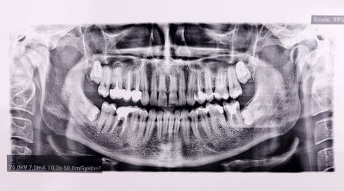 Staying Safe with Dental Radiation