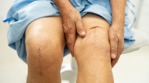 A PT’s Guide to Therapeutic Yoga After Knee Replacement
