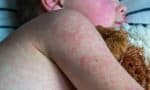 Navigating the Worst-Case Scenario: A Local Measles Outbreak