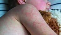 Navigating the Worst-Case Scenario: A Local Measles Outbreak